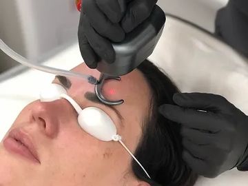 patient wearing eye protection when having CO2 laser done to her face 