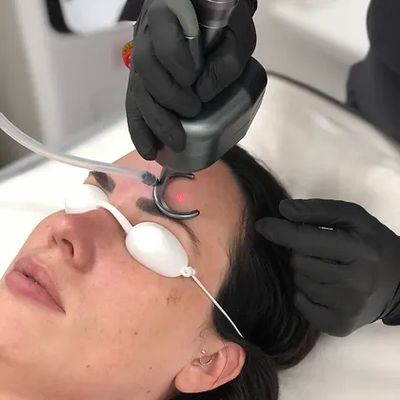 Fractional CO2 laser treatment 