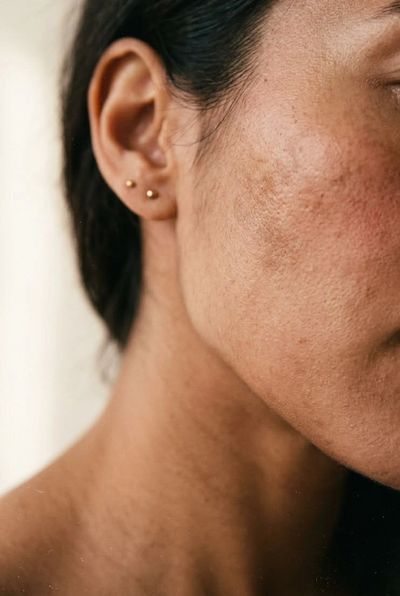 Peau du visage avec cicatrices d'acné visible.