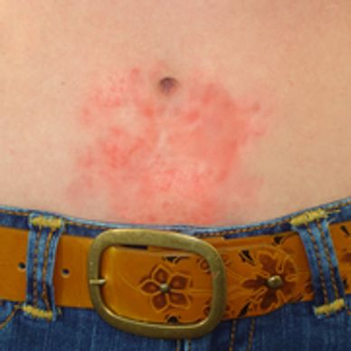 Person with a red rash on stomach caused by nickel in belt buckle.