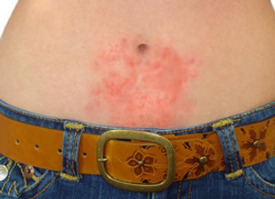 A picture of a stomach rash caused be an allergic reaction to nickel from the belt buckle. 