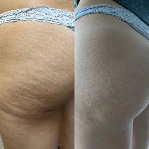  Loose and sunken stretch marks fill out and appear smoother and firmer. 
