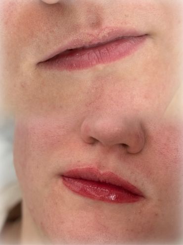 Close-up of lips and nose showing dry and chapped lips.