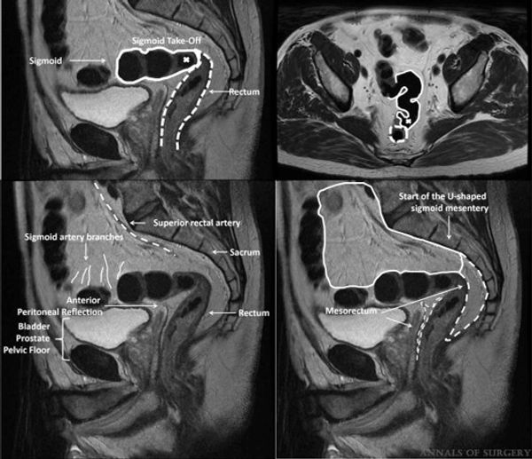 MRI of sigmoid take-off, landmark redefined by Mr Nigel D’Souza for rectal cancer staging.