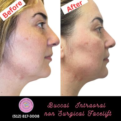 Before and after images of a non-surgical buccal intraoral facelift.