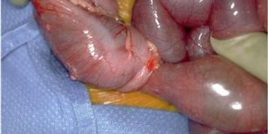 blockage in small intestine,
small bowel resection surgery