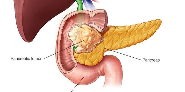 pancreas cancer surgeon,
whipples surgery