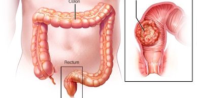colon cancer diagnosis and treatment