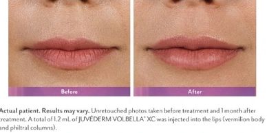 lip filler juvederm lip injections philadelphia