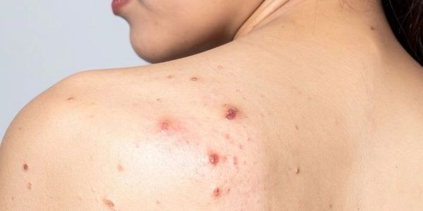Close-up of a person's shoulder with inflamed acne spots and scars.