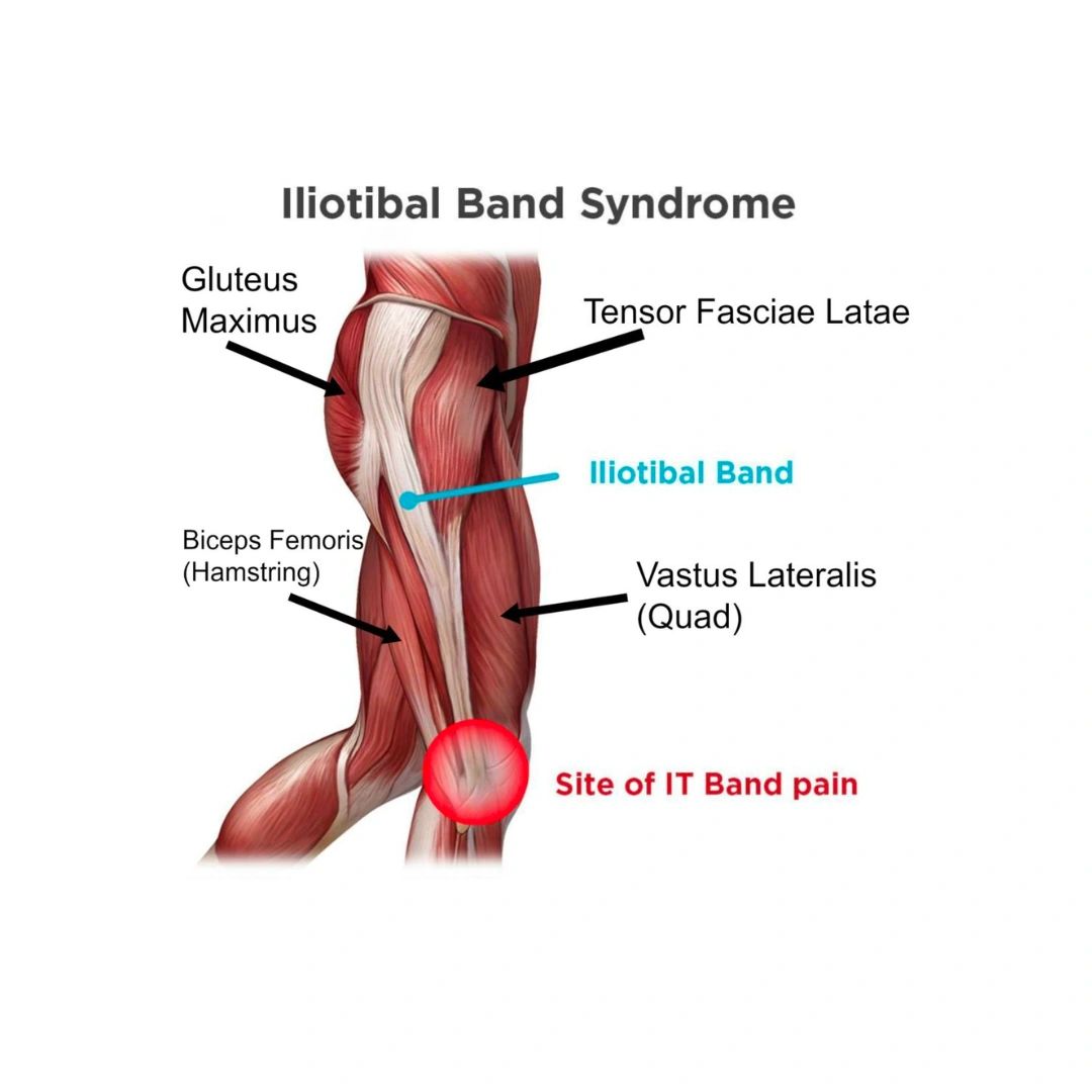 Image showing where the IT Band is located along the exterior of the thigh showing IT Band Pain often experienced on the outside of the knee.