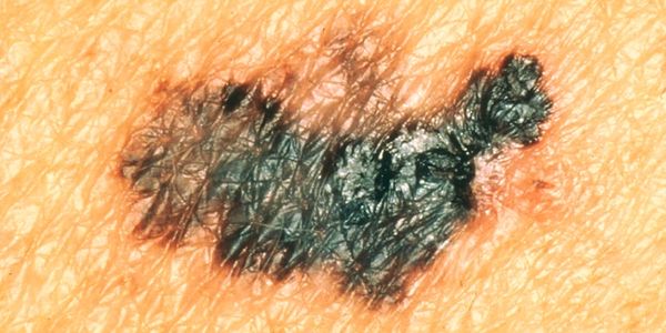 melanoma