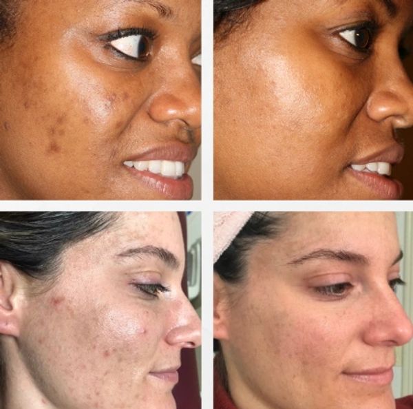 Laser Skin Treatments at Modern Medical Spa Richland WA