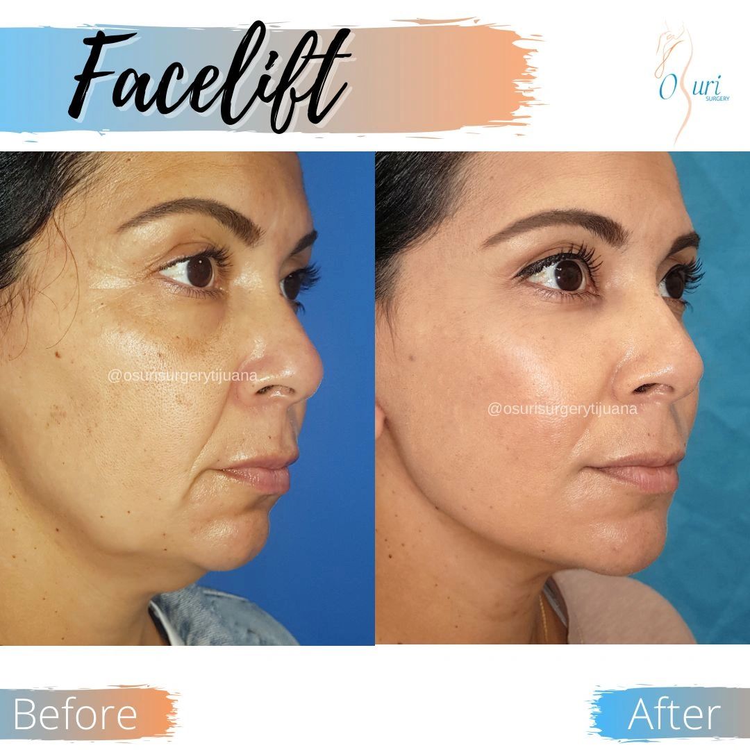 Facelift surgery reduces sagging skin and restores a firmer, more youthful facial appearance.