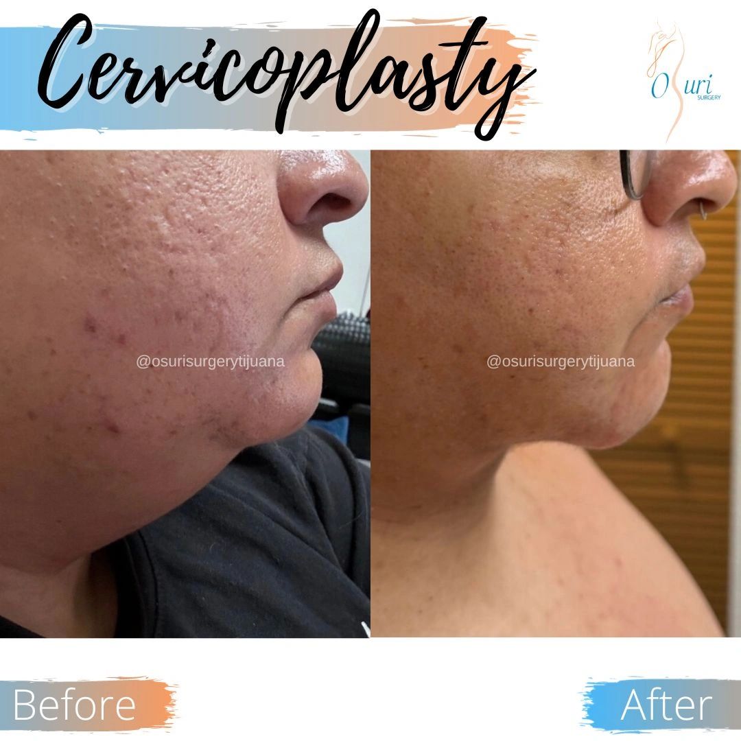 Cervicoplasty removes excess neck skin for a smoother, firmer neckline.