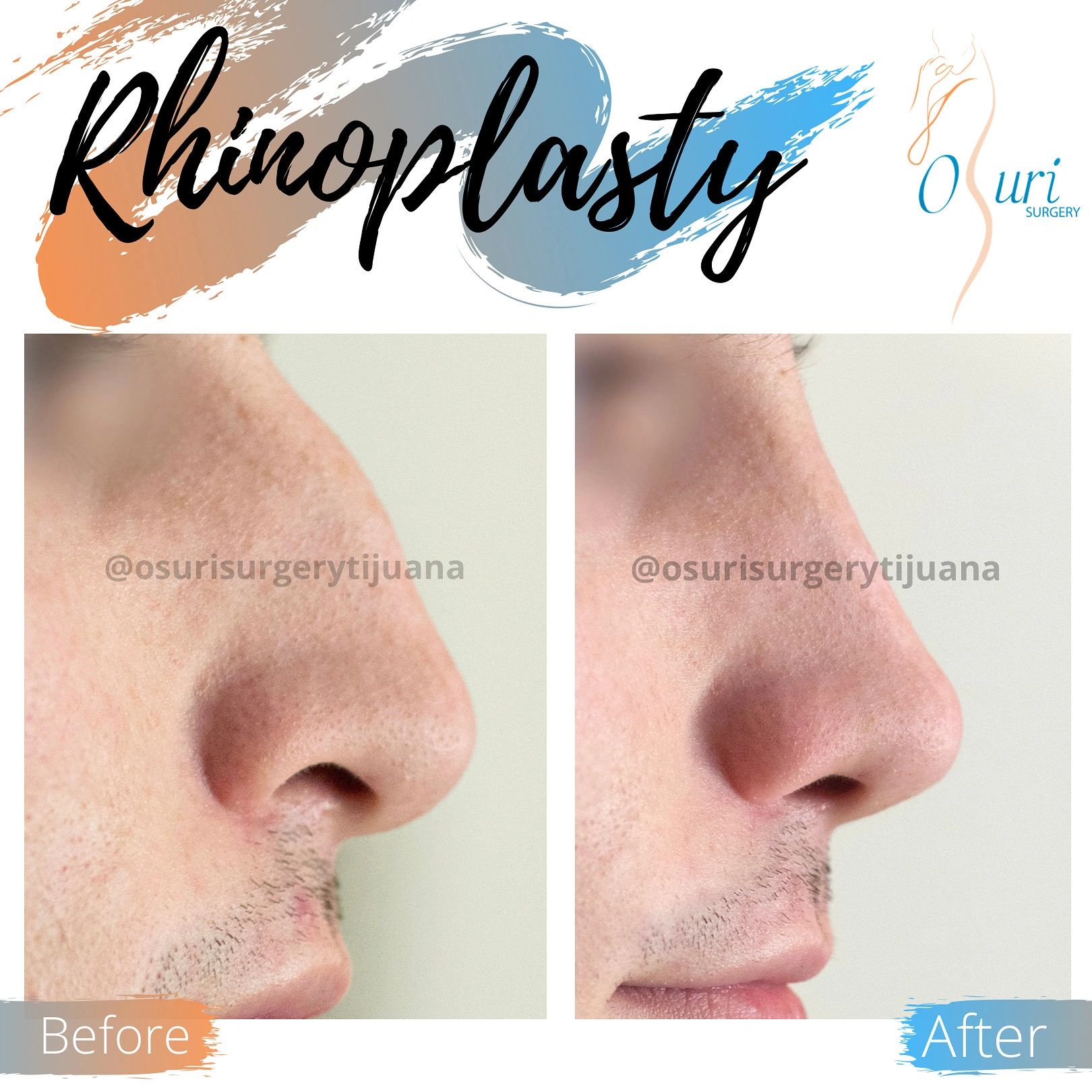 Before-and-after nose comparison following rhinoplasty.