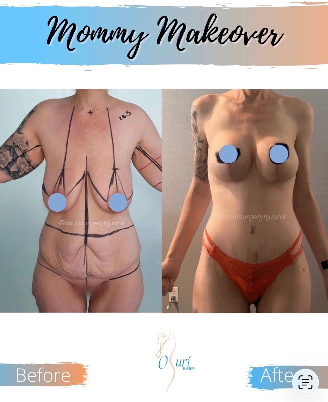 Showing visible improvements in abdominal contour and body proportions.