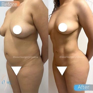 Lipo HD Surgery