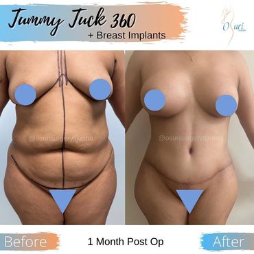 Extended Tummy Tuck 