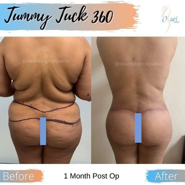 Tummy Tuck 360 with lipo