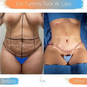 Extended Tummy tuck