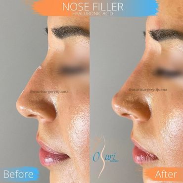 Nose Filler Hyaluronic Acid