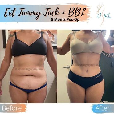 Extended Tummy Tuck