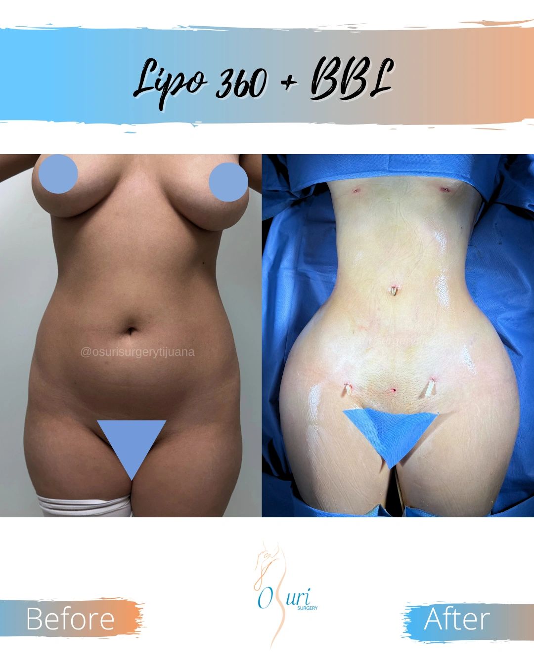 Lipo 360 and bbl (hips)