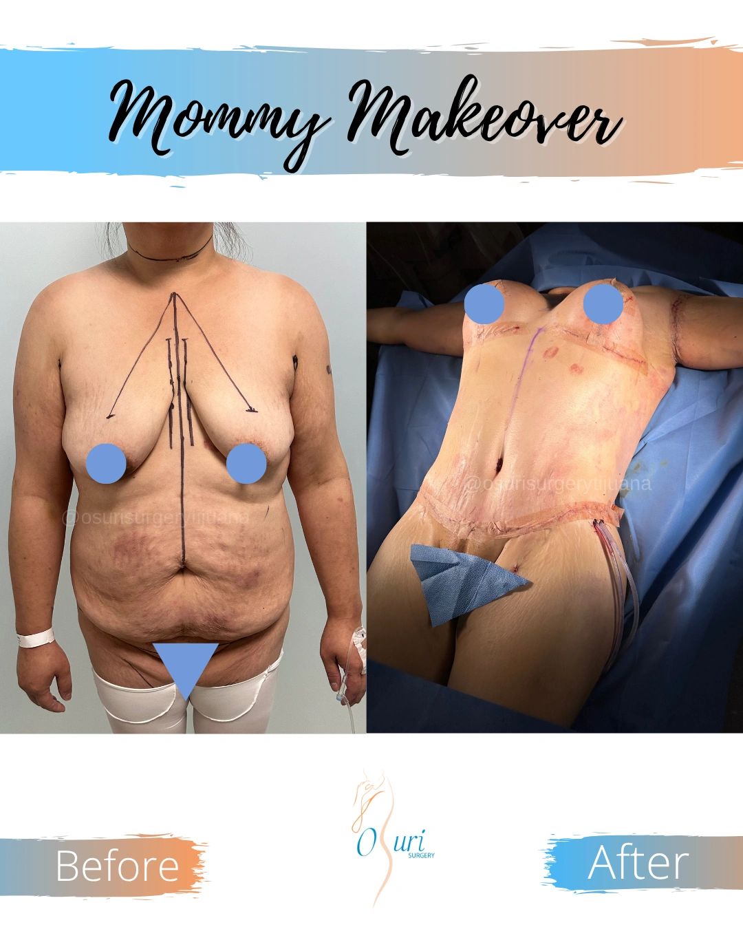 Mommy Makeover surgery combining abdominal contouring and breast enhancement