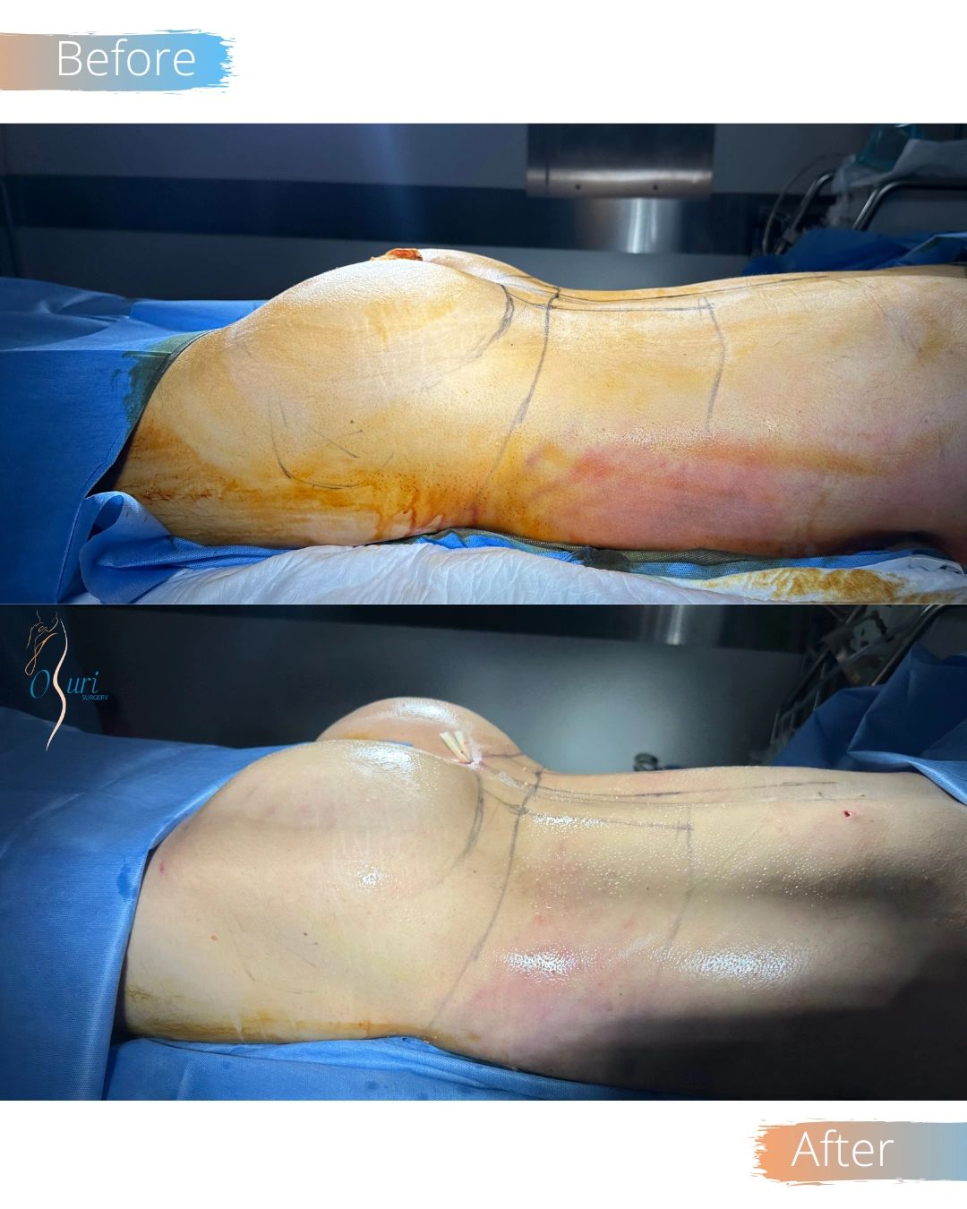 BBL Surgery