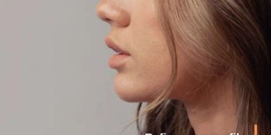 Rhinoplasty surgery in Tijuana, Mexico, to reshape the nose and improve facial harmony.