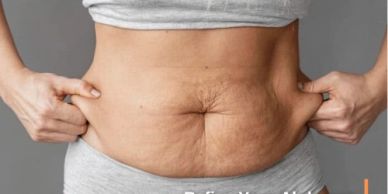 Tummy tuck surgery in Tijuana, Mexico, to remove excess abdominal skin and improve body contours.