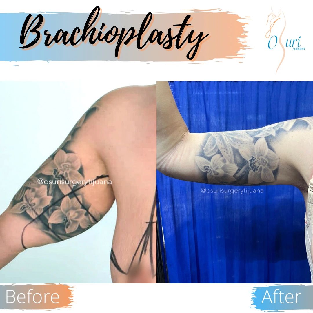 Antes y después de braquioplastia en brazo con tatuaje.