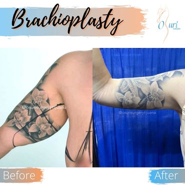 braquioplastia