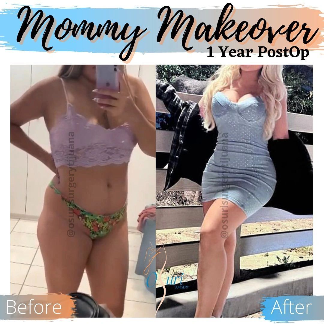 Before and After Breast Lift and Abdominal Skin Removal.