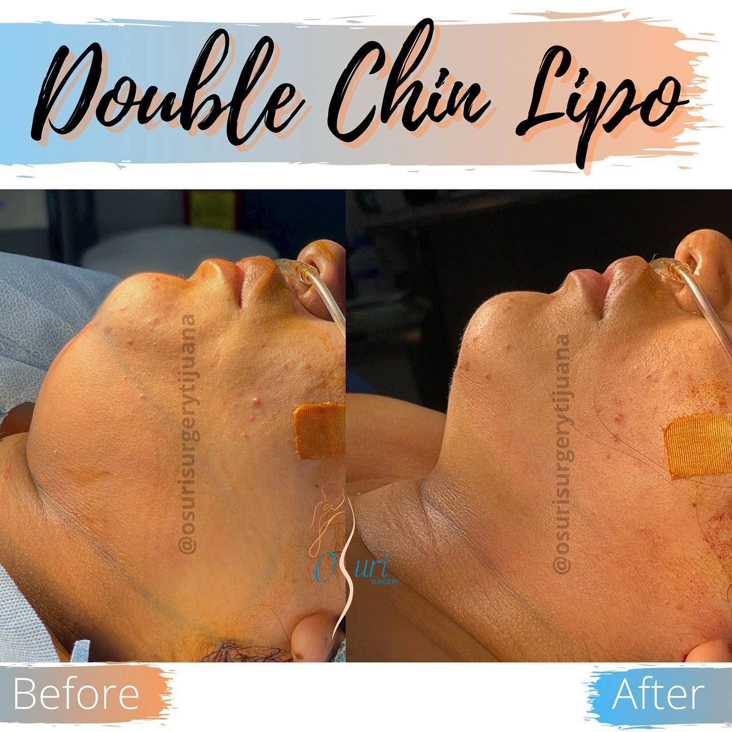Double Chin Liposuction removes excess fat under the chin for a slimmer, more defined jawline.