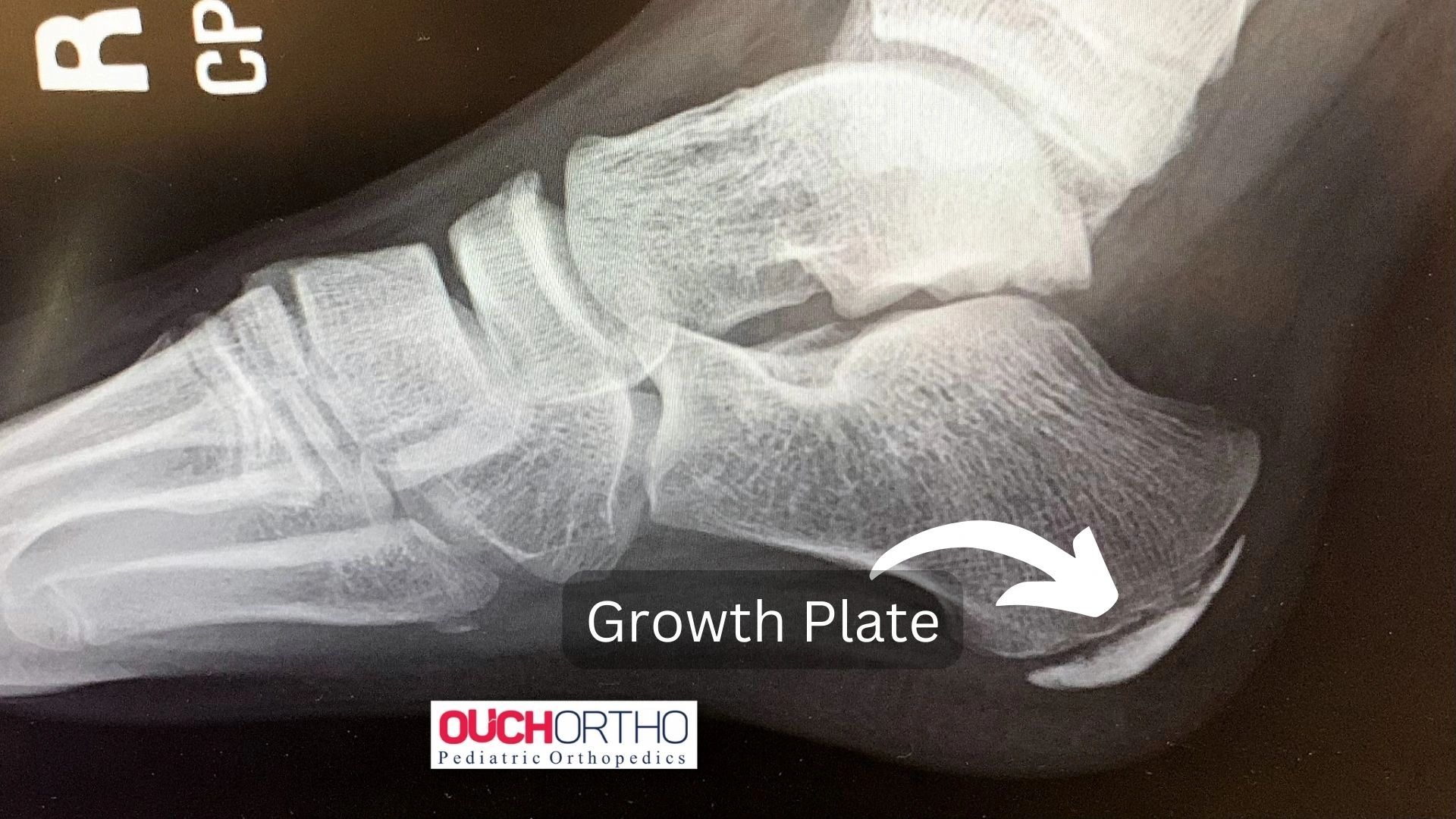 Growth Plate Pain In The Heel Of The Foot Inflammation Of Growth