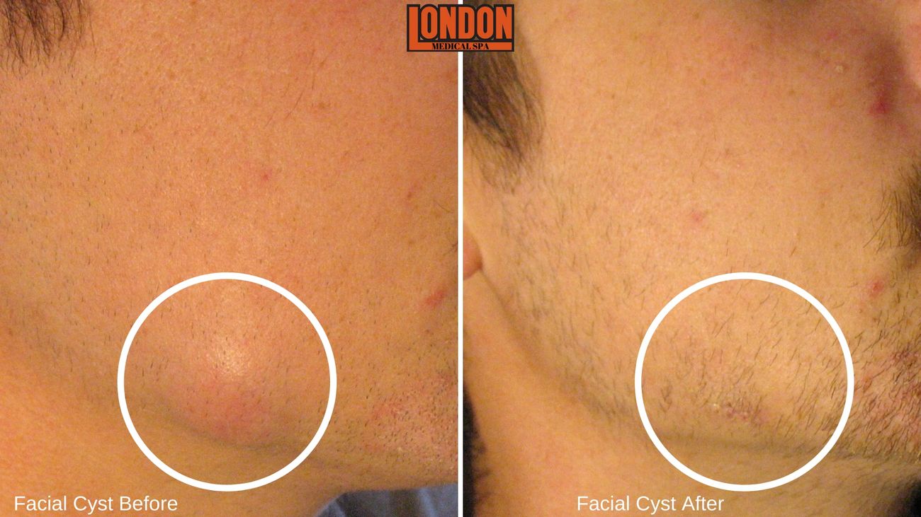 London Medical Spa - CO2 LASER RESURFACING 2/15/22. - Dr. Hal