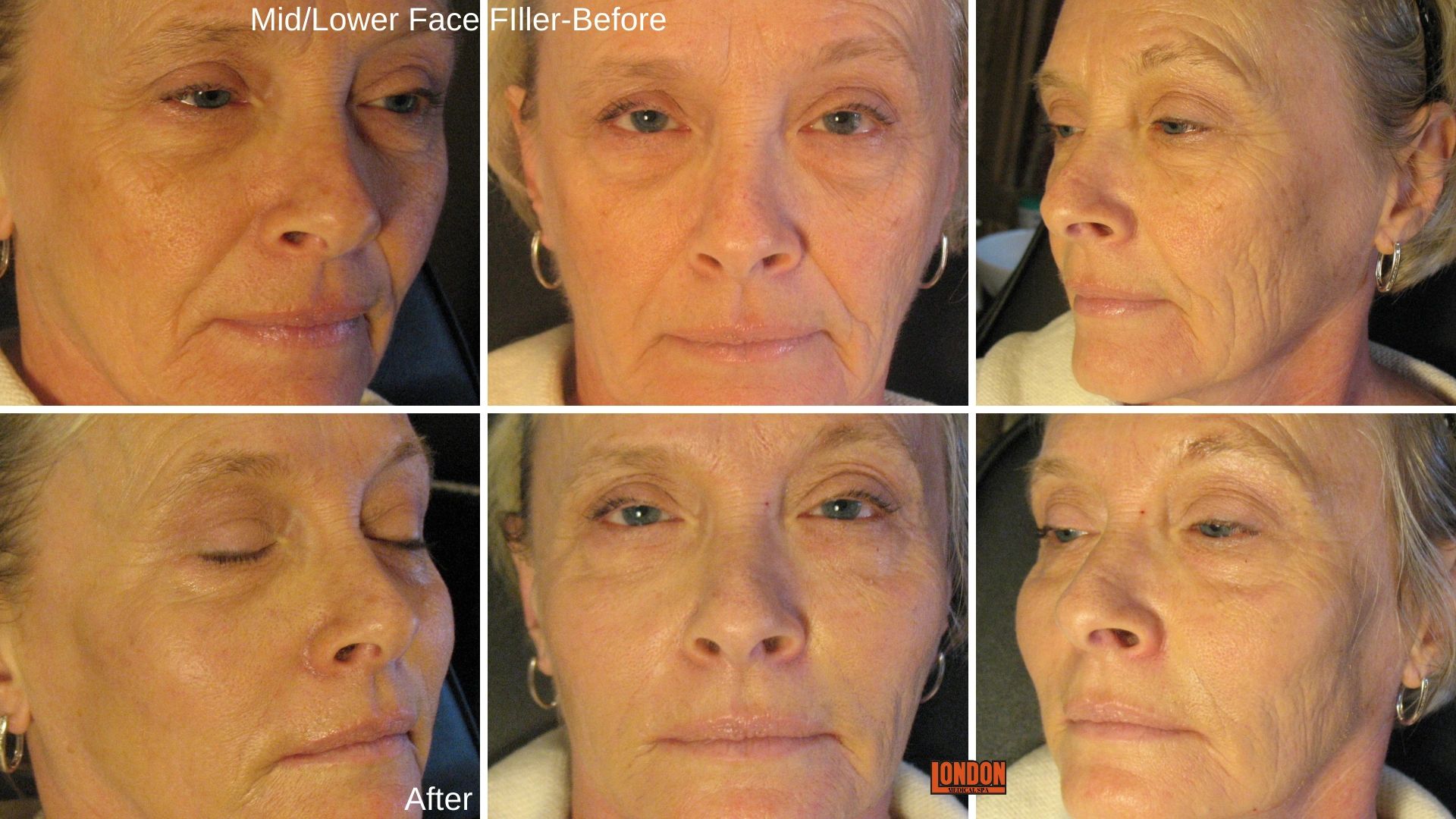 Mid and lower face filler 