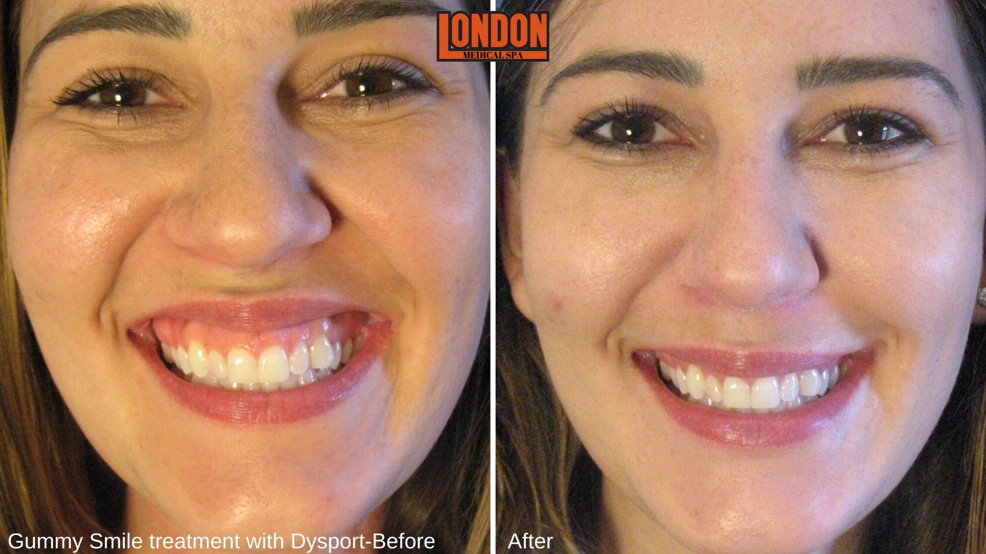 Gummy Smile correction with Dysport