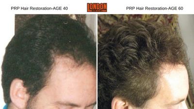 hair loss, alopecia, balding, thin hair, hair restoration, prp, platelet rich plasma, growth factors, minoxadil, finasteride, propecia