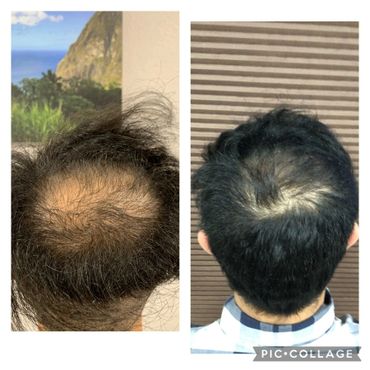 Male Pattern Baldness, now improved after SmartGraft Hair Transplant!