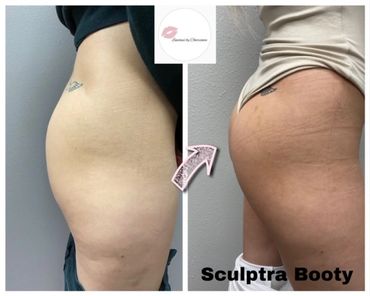 Sculptra is a popular injectable used for a more permanent restoration of volume loss.    
