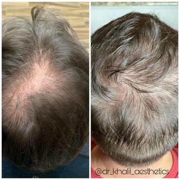 Male Pattern Hair loss in the vertex, restored, with Hair Transplant.