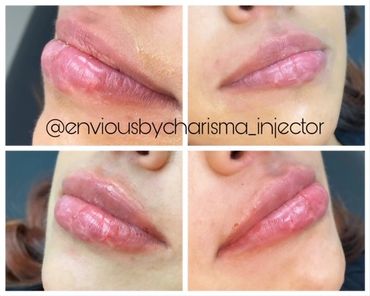 Before and after lip images following dermal filler injection.  Symmetry, projection, volume