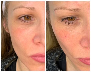 Before and after cheek fillers using VERSA hyaluronic acid filler.   Cheeks and mid-face fillers.