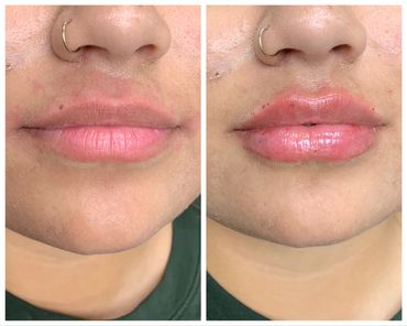 Before and after lip fillers using dermal injection.  Beautiful lips.  