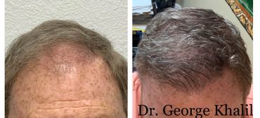 Hairline Restoration using SmartGraft Hair Transplant!