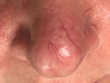Red vein removal or reduction.