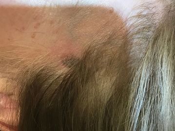 Seborrheic keratosis removal 